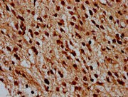 IHC image of CSB-PA010429OA12nbutHU diluted at 1:100 and staining in paraffin-embedded human glioma performed on a Leica BondTM system. After dewaxing and hydration, antigen retrieval was mediated by high pressure in a citrate buffer (pH 6.0). Sec...