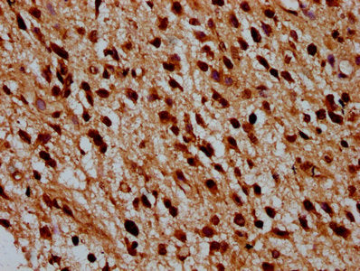 IHC image of CSB-PA010429OA12nbutHU diluted at 1:100 and staining in paraffin-embedded human glioma performed on a Leica BondTM system. After dewaxing and hydration, antigen retrieval was mediated by high pressure in a citrate buffer (pH 6.0). Sec...