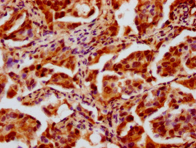 IHC image of CSB-PA010429OA12nhibHU diluted at 1:20 and staining in paraffin-embedded human lung cancer performed on a Leica BondTM system. After dewaxing and hydration, antigen retrieval was mediated by high pressure in a citrate buffer (pH 6.0)....