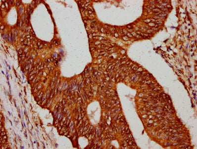 IHC image of CSB-PA010429OA12npropHU diluted at 1:75 and staining in paraffin-embedded human colon cancer performed on a Leica BondTM system. After dewaxing and hydration, antigen retrieval was mediated by high pressure in a citrate buffer (pH 6.0...