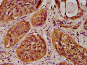 IHC image of CSB-PA010429OA20nme3HU diluted at 1:100 and staining in paraffin-embedded human cervical cancer performed on a Leica BondTM system. After dewaxing and hydration, antigen retrieval was mediated by high pressure in a citrate buffer (pH...