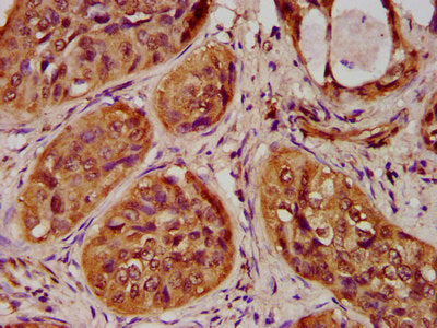 IHC image of CSB-PA010429OA20nme3HU diluted at 1:100 and staining in paraffin-embedded human cervical cancer performed on a Leica BondTM system. After dewaxing and hydration, antigen retrieval was mediated by high pressure in a citrate buffer (pH...