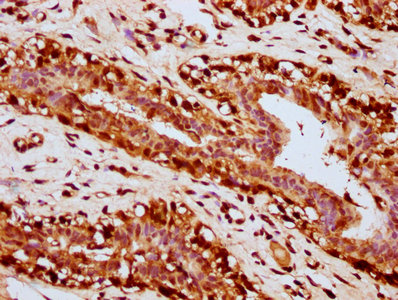 IHC image of CSB-PA010429OA31nacHU diluted at 1:20 and staining in paraffin-embedded human breast cancer performed on a Leica BondTM system. After dewaxing and hydration, antigen retrieval was mediated by high pressure in a citrate buffer (pH 6.0)...