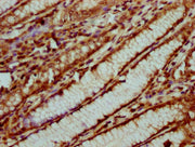 IHC image of CSB-PA010429OA31nsucHU diluted at 1:20 and staining in paraffin-embedded human gastric cancer performed on a Leica BondTM system. After dewaxing and hydration, antigen retrieval was mediated by high pressure in a citrate buffer (pH 6....