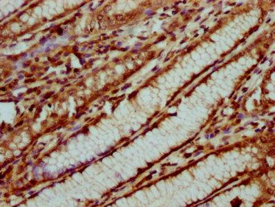 IHC image of CSB-PA010429OA31nsucHU diluted at 1:20 and staining in paraffin-embedded human gastric cancer performed on a Leica BondTM system. After dewaxing and hydration, antigen retrieval was mediated by high pressure in a citrate buffer (pH 6....