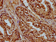 IHC image of CSB-PA010429OA35nme1HU diluted at 1:25 and staining in paraffin-embedded human prostate cancer performed on a Leica BondTM system. After dewaxing and hydration, antigen retrieval was mediated by high pressure in a citrate buffer (pH 6...
