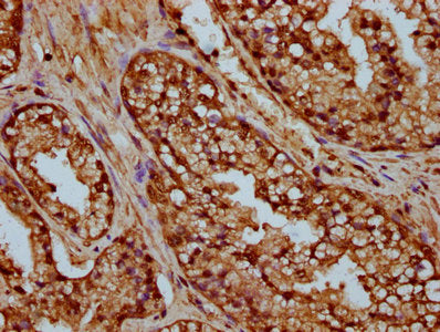IHC image of CSB-PA010429OA35nme1HU diluted at 1:25 and staining in paraffin-embedded human prostate cancer performed on a Leica BondTM system. After dewaxing and hydration, antigen retrieval was mediated by high pressure in a citrate buffer (pH 6...