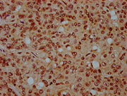 IHC image of CSB-PA010429OA44nbutHU diluted at 1:15 and staining in paraffin-embedded human liver cancer performed on a Leica BondTM system. After dewaxing and hydration, antigen retrieval was mediated by high pressure in a citrate buffer (pH 6.0)...