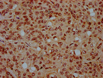 IHC image of CSB-PA010429OA44nbutHU diluted at 1:15 and staining in paraffin-embedded human liver cancer performed on a Leica BondTM system. After dewaxing and hydration, antigen retrieval was mediated by high pressure in a citrate buffer (pH 6.0)...