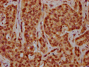 IHC image of CSB-PA010429OA44nhibHU diluted at 1:10 and staining in paraffin-embedded human liver cancer performed on a Leica BondTM system. After dewaxing and hydration, antigen retrieval was mediated by high pressure in a citrate buffer (pH 6.0)...
