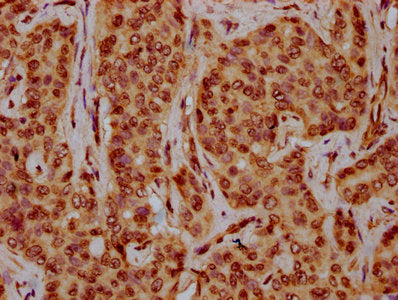 IHC image of CSB-PA010429OA44nhibHU diluted at 1:10 and staining in paraffin-embedded human liver cancer performed on a Leica BondTM system. After dewaxing and hydration, antigen retrieval was mediated by high pressure in a citrate buffer (pH 6.0)...