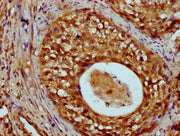 IHC image of CSB-PA010429OA55nme1HU diluted at 1:20 and staining in paraffin-embedded human cervical cancer performed on a Leica BondTM system. After dewaxing and hydration, antigen retrieval was mediated by high pressure in a citrate buffer (pH 6...