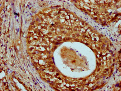 IHC image of CSB-PA010429OA55nme1HU diluted at 1:20 and staining in paraffin-embedded human cervical cancer performed on a Leica BondTM system. After dewaxing and hydration, antigen retrieval was mediated by high pressure in a citrate buffer (pH 6...