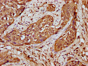 IHC image of CSB-PA010429OA59nforHU diluted at 1:20 and staining in paraffin-embedded human cervical cancer performed on a Leica BondTM system. After dewaxing and hydration, antigen retrieval was mediated by high pressure in a citrate buffer (pH 6...
