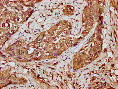 IHC image of CSB-PA010429OA59nforHU diluted at 1:20 and staining in paraffin-embedded human cervical cancer performed on a Leica BondTM system. After dewaxing and hydration, antigen retrieval was mediated by high pressure in a citrate buffer (pH 6...