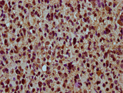 IHC image of CSB-PA010429OA59nme1HU diluted at 1:30 and staining in paraffin-embedded human glioma performed on a Leica BondTM system. After dewaxing and hydration, antigen retrieval was mediated by high pressure in a citrate buffer (pH 6.0). Sect...