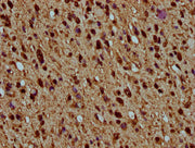 IHC image of CSB-PA010429OA77nhibHU diluted at 1:5 and staining in paraffin-embedded human glioma performed on a Leica BondTM system. After dewaxing and hydration, antigen retrieval was mediated by high pressure in a citrate buffer (pH 6.0). Secti...