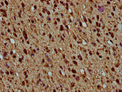 IHC image of CSB-PA010429OA77nhibHU diluted at 1:5 and staining in paraffin-embedded human glioma performed on a Leica BondTM system. After dewaxing and hydration, antigen retrieval was mediated by high pressure in a citrate buffer (pH 6.0). Secti...