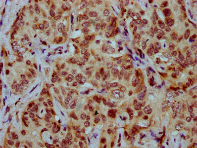 IHC image of CSB-PA010429OA77nsucHU diluted at 1:20 and staining in paraffin-embedded human liver cancer performed on a Leica BondTM system. After dewaxing and hydration, antigen retrieval was mediated by high pressure in a citrate buffer (pH 6.0)...