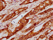IHC image of CSB-PA010429OA79nbutHU diluted at 1:20 and staining in paraffin-embedded human colon cancer performed on a Leica BondTM system. After dewaxing and hydration, antigen retrieval was mediated by high pressure in a citrate buffer (pH 6.0)...
