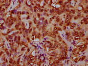 IHC image of CSB-PA010429OA79nforHU diluted at 1:5 and staining in paraffin-embedded human liver cancer performed on a Leica BondTM system. After dewaxing and hydration, antigen retrieval was mediated by high pressure in a citrate buffer (pH 6.0)....