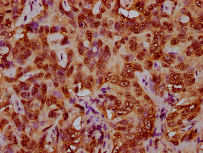 IHC image of CSB-PA010429OA79nforHU diluted at 1:5 and staining in paraffin-embedded human liver cancer performed on a Leica BondTM system. After dewaxing and hydration, antigen retrieval was mediated by high pressure in a citrate buffer (pH 6.0)....