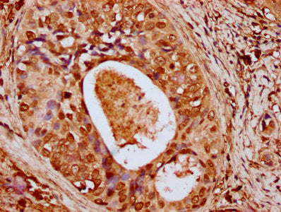 IHC image of CSB-PA010429OA79nhibHU diluted at 1:10 and staining in paraffin-embedded human cervical cancer performed on a Leica BondTM system. After dewaxing and hydration, antigen retrieval was mediated by high pressure in a citrate buffer (pH 6...
