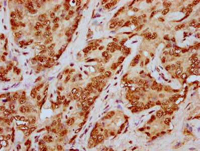 IHC image of CSB-PA010429OA79npropHU diluted at 1:20 and staining in paraffin-embedded human liver cancer performed on a Leica BondTM system. After dewaxing and hydration, antigen retrieval was mediated by high pressure in a citrate buffer (pH 6.0...