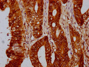 IHC image of CSB-PA010429OA88nohHU diluted at 1:10 and staining in paraffin-embedded human colon cancer performed on a Leica BondTM system. After dewaxing and hydration, antigen retrieval was mediated by high pressure in a citrate buffer (pH 6.0)....