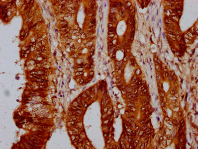 IHC image of CSB-PA010429OA88nohHU diluted at 1:10 and staining in paraffin-embedded human colon cancer performed on a Leica BondTM system. After dewaxing and hydration, antigen retrieval was mediated by high pressure in a citrate buffer (pH 6.0)....
