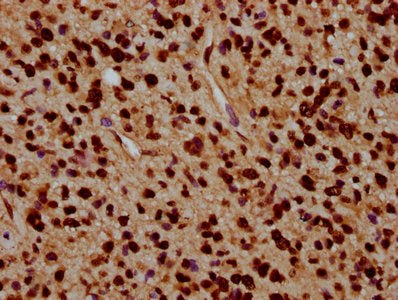 IHC image of CSB-PA010429OA91nacHU diluted at 1:5 and staining in paraffin-embedded human glioma performed on a Leica BondTM system. After dewaxing and hydration, antigen retrieval was mediated by high pressure in a citrate buffer (pH 6.0). Sectio...