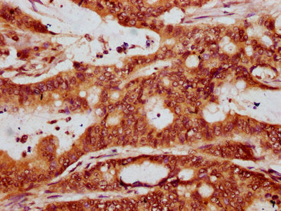 IHC image of CSB-PA010429OA91nbhbHU diluted at 1:20 and staining in paraffin-embedded human colon cancer performed on a Leica BondTM system. After dewaxing and hydration, antigen retrieval was mediated by high pressure in a citrate buffer (pH 6.0)...