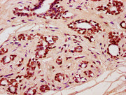 IHC image of CSB-PA010429OA91nforHU diluted at 1:20 and staining in paraffin-embedded human breast cancer performed on a Leica BondTM system. After dewaxing and hydration, antigen retrieval was mediated by high pressure in a citrate buffer (pH 6.0...
