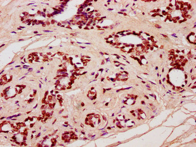 IHC image of CSB-PA010429OA91nforHU diluted at 1:20 and staining in paraffin-embedded human breast cancer performed on a Leica BondTM system. After dewaxing and hydration, antigen retrieval was mediated by high pressure in a citrate buffer (pH 6.0...