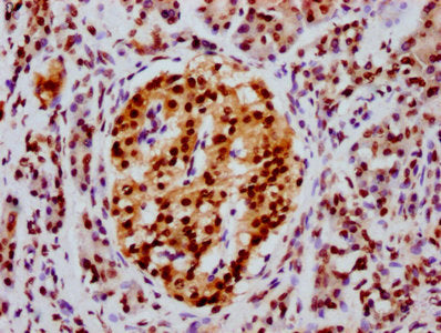IHC image of CSB-PA010429OA91npropHU diluted at 1:20 and staining in paraffin-embedded human pancreatic cancer performed on a Leica BondTM system. After dewaxing and hydration, antigen retrieval was mediated by high pressure in a citrate buffer (p...