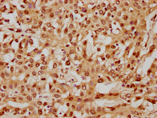 IHC image of CSB-PA010429PA05nhibHU diluted at 1:8 and staining in paraffin-embedded human liver cancer performed on a Leica BondTM system. After dewaxing and hydration, antigen retrieval was mediated by high pressure in a citrate buffer (pH 6.0)....