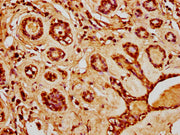 IHC image of CSB-PA010429PA20nacHU diluted at 1:20 and staining in paraffin-embedded human breast cancer performed on a Leica BondTM system. After dewaxing and hydration, antigen retrieval was mediated by high pressure in a citrate buffer (pH 6.0)...