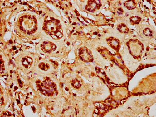 IHC image of CSB-PA010429PA20nacHU diluted at 1:20 and staining in paraffin-embedded human breast cancer performed on a Leica BondTM system. After dewaxing and hydration, antigen retrieval was mediated by high pressure in a citrate buffer (pH 6.0)...