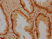 IHC image of CSB-PA010429PA31nbutHU diluted at 1:20 and staining in paraffin-embedded human prostate cancer performed on a Leica BondTM system. After dewaxing and hydration, antigen retrieval was mediated by high pressure in a citrate buffer (pH 6...