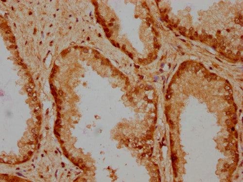 IHC image of CSB-PA010429PA31nbutHU diluted at 1:20 and staining in paraffin-embedded human prostate cancer performed on a Leica BondTM system. After dewaxing and hydration, antigen retrieval was mediated by high pressure in a citrate buffer (pH 6...