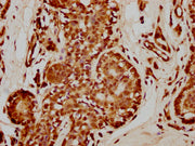 IHC image of CSB-PA010429PA35nme1HU diluted at 1:50 and staining in paraffin-embedded human breast cancer performed on a Leica BondTM system. After dewaxing and hydration, antigen retrieval was mediated by high pressure in a citrate buffer (pH 6.0...