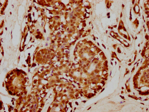 IHC image of CSB-PA010429PA35nme1HU diluted at 1:50 and staining in paraffin-embedded human breast cancer performed on a Leica BondTM system. After dewaxing and hydration, antigen retrieval was mediated by high pressure in a citrate buffer (pH 6.0...