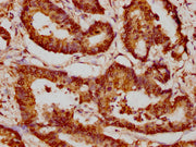 IHC image of CSB-PA010429PA77nacHU diluted at 1:20 and staining in paraffin-embedded human colon cancer performed on a Leica BondTM system. After dewaxing and hydration, antigen retrieval was mediated by high pressure in a citrate buffer (pH 6.0)....