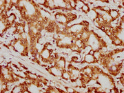 IHC image of CSB-PA010429PA79nforHU diluted at 1:20 and staining in paraffin-embedded human colon cancer performed on a Leica BondTM system. After dewaxing and hydration, antigen retrieval was mediated by high pressure in a citrate buffer (pH 6.0)...