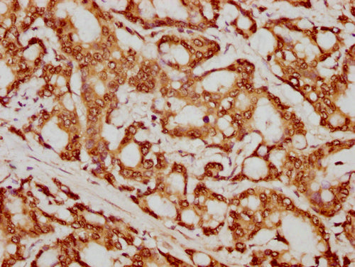 IHC image of CSB-PA010429PA79nforHU diluted at 1:20 and staining in paraffin-embedded human colon cancer performed on a Leica BondTM system. After dewaxing and hydration, antigen retrieval was mediated by high pressure in a citrate buffer (pH 6.0)...