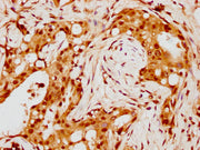 IHC image of CSB-PA010429PA88nohHU diluted at 1:8 and staining in paraffin-embedded human breast cancer performed on a Leica BondTM system. After dewaxing and hydration, antigen retrieval was mediated by high pressure in a citrate buffer (pH 6.0)....