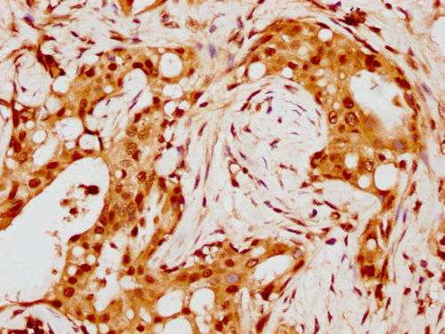 IHC image of CSB-PA010429PA88nohHU diluted at 1:8 and staining in paraffin-embedded human breast cancer performed on a Leica BondTM system. After dewaxing and hydration, antigen retrieval was mediated by high pressure in a citrate buffer (pH 6.0)....