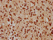IHC image of CSB-PA010429PA91nacHU diluted at 1:20 and staining in paraffin-embedded human glioma cancer performed on a Leica BondTM system. After dewaxing and hydration, antigen retrieval was mediated by high pressure in a citrate buffer (pH 6.0)...
