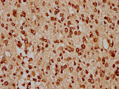 IHC image of CSB-PA010429PA91nacHU diluted at 1:20 and staining in paraffin-embedded human glioma cancer performed on a Leica BondTM system. After dewaxing and hydration, antigen retrieval was mediated by high pressure in a citrate buffer (pH 6.0)...