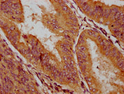 IHC image of CSB-PA010518LA01HU diluted at 1:200 and staining in paraffin-embedded human endometrial cancer performed on a Leica BondTM system. After dewaxing and hydration, antigen retrieval was mediated by high pressure in a citrate buffer (pH 6...